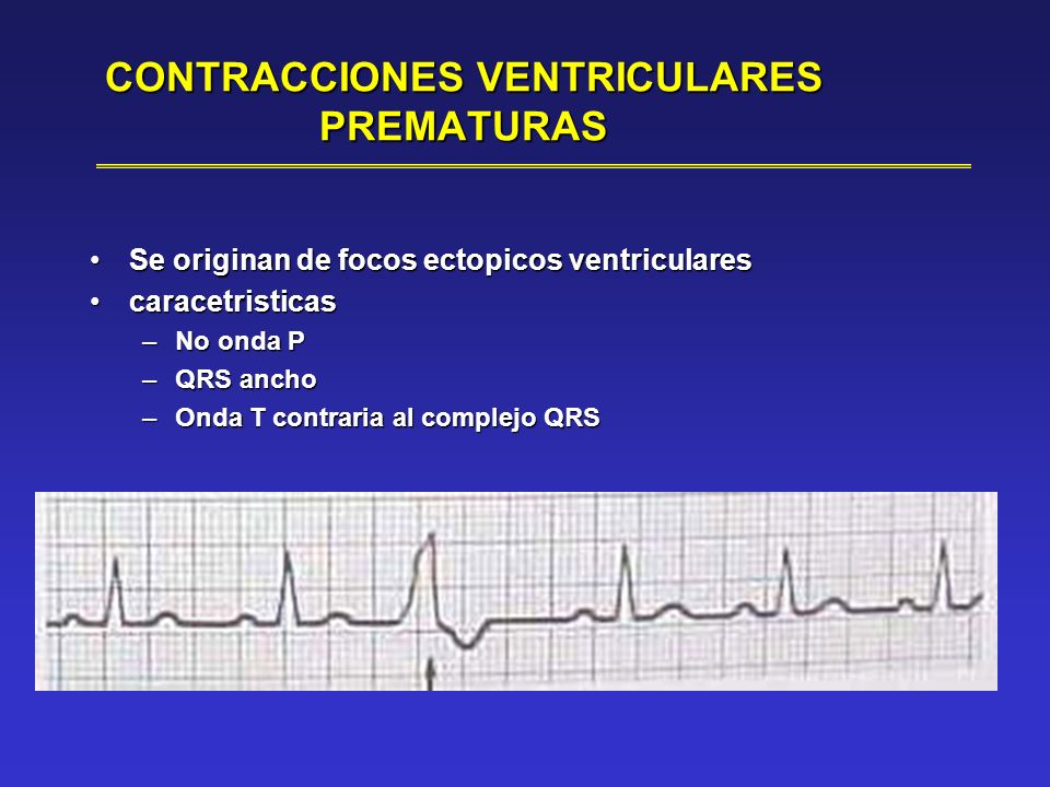 contracciones ventriculares prematuras